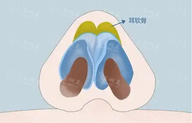 自体隆鼻是否存在副作用?一文了解真相