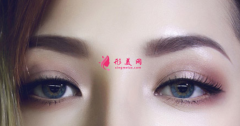 埋线双眼皮怎么快速恢复？