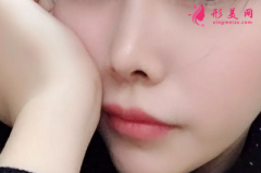 做了鼻翼缩小手术会有后遗症吗？