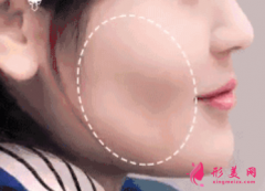 自体脂肪填充脸部前要做什么准备？