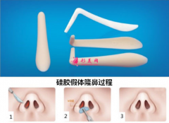 假体隆鼻的效果和维持时间