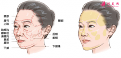 自体脂肪填充脸部会有血肿吗？