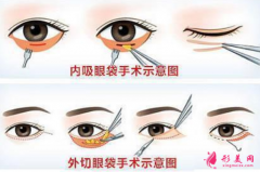 手术祛眼袋的恢复期要多久？