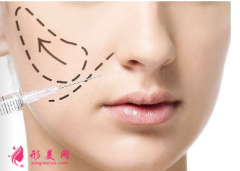 脸部填充玻尿酸可以保持多久？