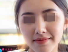 自体脂肪填充脸部有什么风险吗？