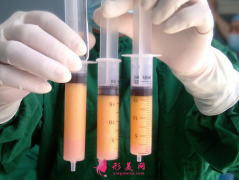 自体脂肪填充脸部消肿时间？