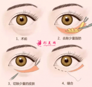 手术切除眼袋术后护理方法