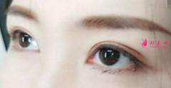 埋线双眼皮一般多少钱？