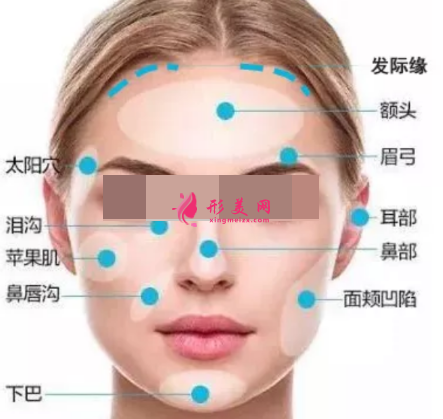 自体脂肪填充脸部会有后遗症吗