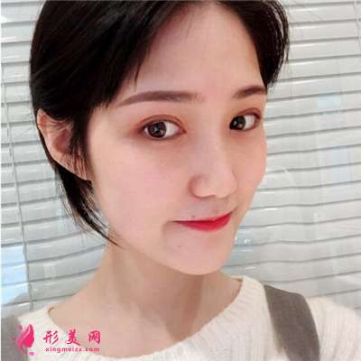 郑州切开双眼皮术后案例反馈,小姐姐长得好可爱啊~ 术后 郑州切开双眼皮术后案例反馈,小姐姐长得好可爱啊~