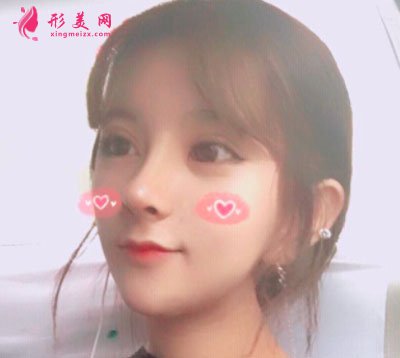 天津圣韩美医疗美容肋软骨隆鼻案例