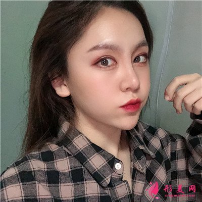成都小姐姐的鼻综合手术术后效果分享图 术后 成都小姐姐的鼻综合手术术后效果分享图