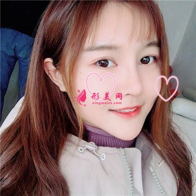 杭州肋软骨隆鼻术后恢复情况对比 术后 杭州肋软骨隆鼻术后恢复情况对比