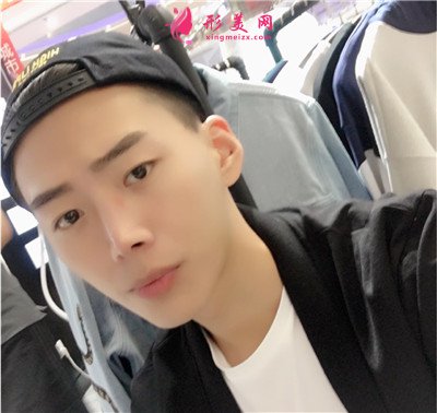 福州小哥哥鼻综合术后恢复效果反馈 术后 福州小哥哥鼻综合术后恢复效果反馈