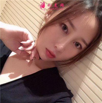 云南新华发际线种植术后恢复情况分享 术后 云南新华发际线种植术后恢复情况分享