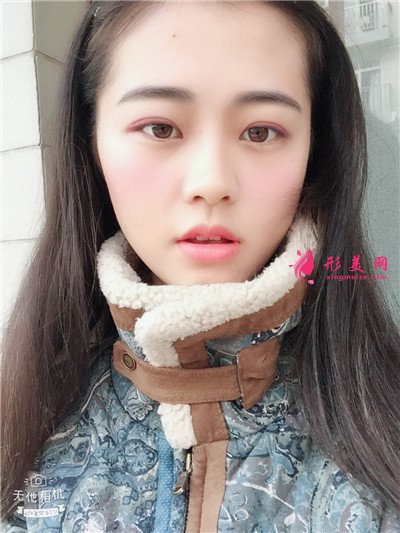 武汉全切双眼皮术后恢复效果展示分享 术后 武汉全切双眼皮术后恢复效果展示分享