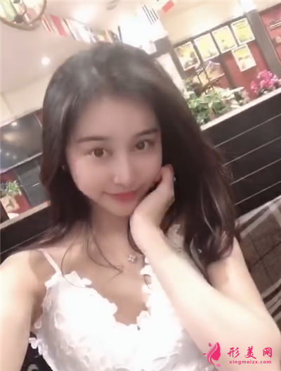 成都恒博种植发际线手术术后效果展示