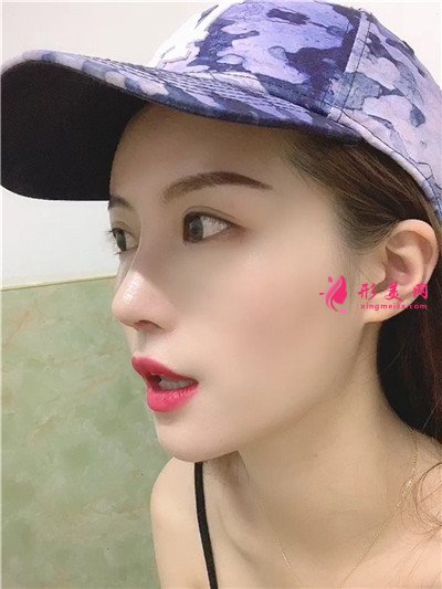 济南鼻综合手术术后恢复情况对比 术后 济南鼻综合手术术后恢复情况对比