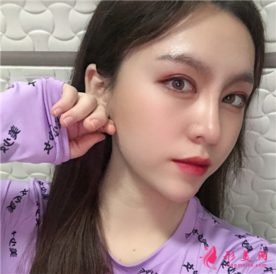 成都鼻综合手术术后恢复效果对比 术后 成都鼻综合手术术后恢复效果对比