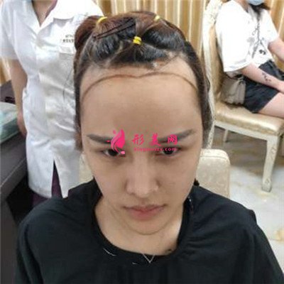 厦门发际线移植手术术后效果反馈