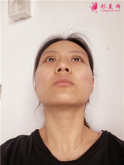 深圳眼综合手术术后恢复情况对比