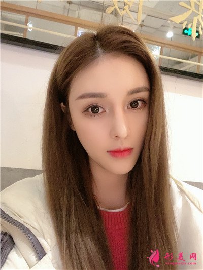 重庆耳软骨隆鼻术后恢复效果分享 术后 重庆耳软骨隆鼻术后恢复效果分享