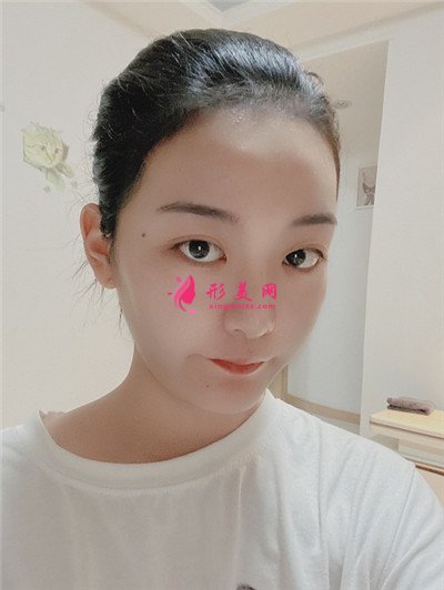 杭州发际线调整术后恢复效果对比 术后 杭州发际线调整术后恢复效果对比