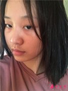 杭州华山连天美医疗美容医院面部埋线提升术后恢复情况分析