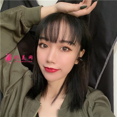 苏州小姐姐全切双眼皮术后效果对比 术后 苏州小姐姐全切双眼皮术后效果对比