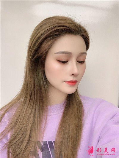 广州耳软骨隆鼻术后恢复情况对比 术后 广州耳软骨隆鼻术后恢复情况对比