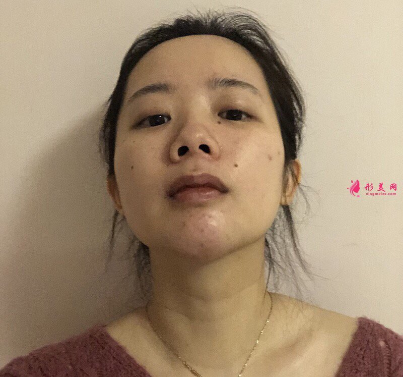 深圳富华曹梦君医师真人案例 隆鼻110天前后对比图分享