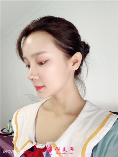 南昌假体隆鼻术后恢复情况对比 术后 南昌假体隆鼻术后恢复情况对比