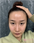 成都恒博植发发际线植发贵不贵？案例效果一览