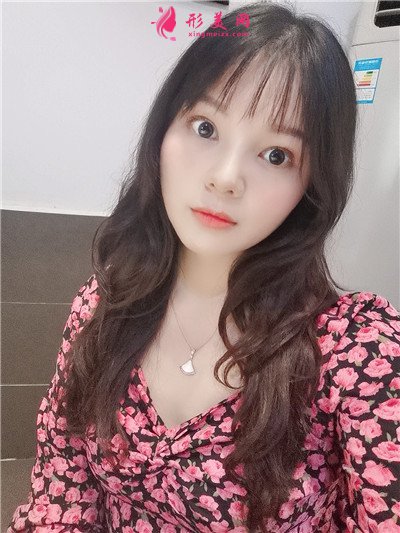 广州小姐姐鼻综合手术术后效果展示 术后 广州小姐姐鼻综合手术术后效果展示