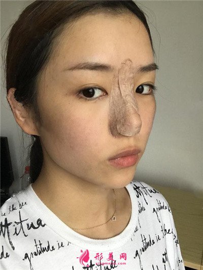 重庆小仙女膨体隆鼻术后恢复情况展示