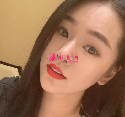 长虹医疗分享光子嫩肤真实案例 术后94天效果图