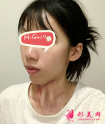 苏州疤痕修复，爱思特医院激光疤痕修复案例，疤痕不见了