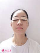 郑州大学第二附属医院全切双眼皮手术术后效果分享