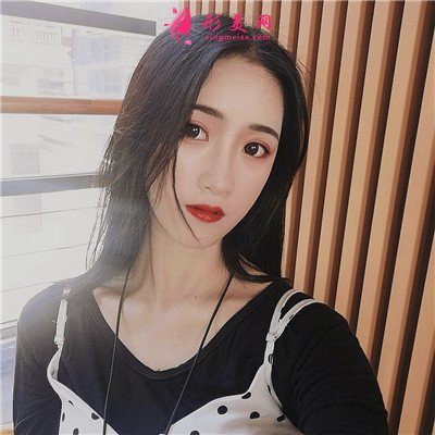 厦门全切双眼皮手术术后效果分享 术后 厦门全切双眼皮手术术后效果分享