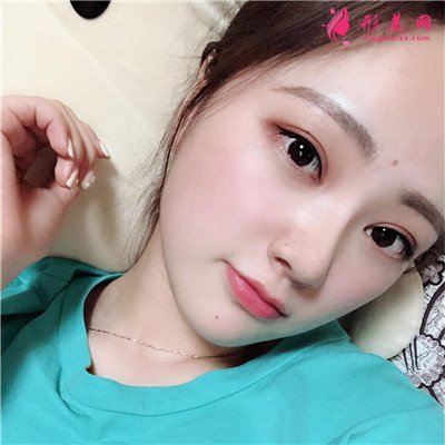 南昌眼部综合手术术后效果反馈 术后 南昌眼部综合手术术后效果反馈