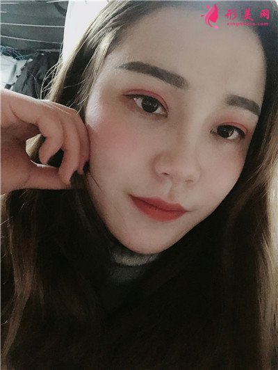 成都小仙女全切双眼皮手术术后效果对比