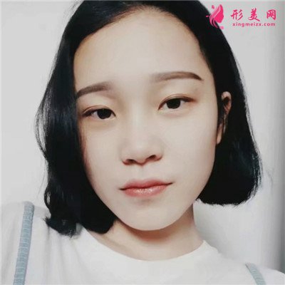 成都小仙女全切双眼皮手术术后效果对比