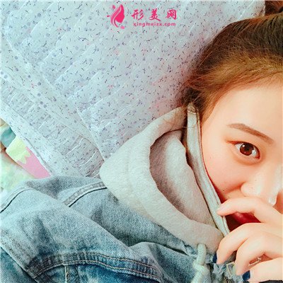 河南彩光嫩肤术后恢复效果展示 术后 河南彩光嫩肤术后恢复效果展示