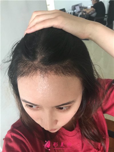 重庆种植发际线手术术后效果分享 术后 重庆种植发际线手术术后效果分享