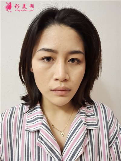 郑州耳软骨隆鼻术后恢复情况对比分享