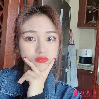 成都小姐姐面部吸脂术后恢复情况分享 术后 成都小姐姐面部吸脂术后恢复情况分享