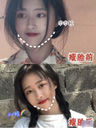 重庆军美武剑医生做的面部吸脂手术，重塑面部轮廓