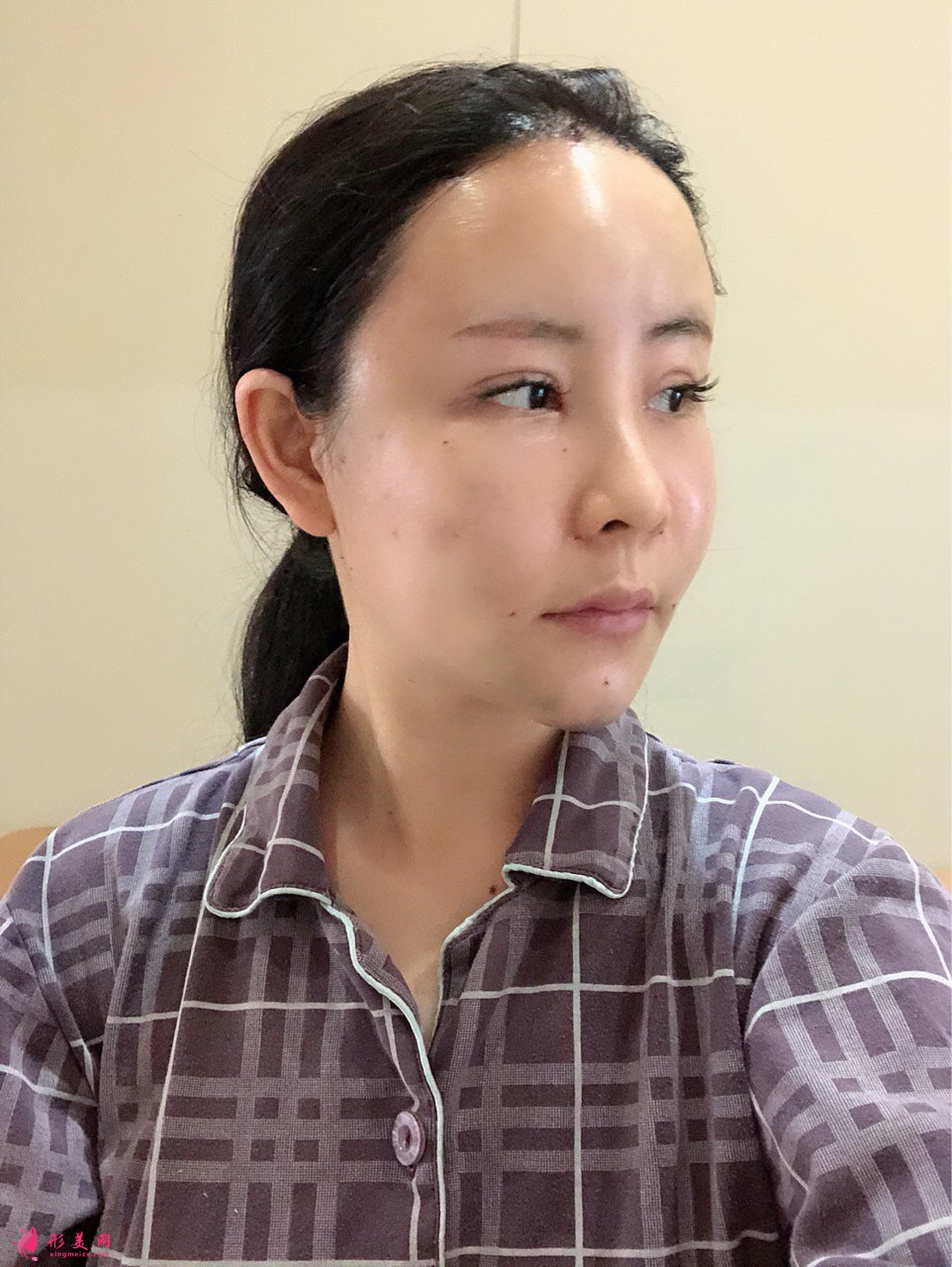 上海美莱医疗美容价格表，附自体脂肪丰额头案例分享