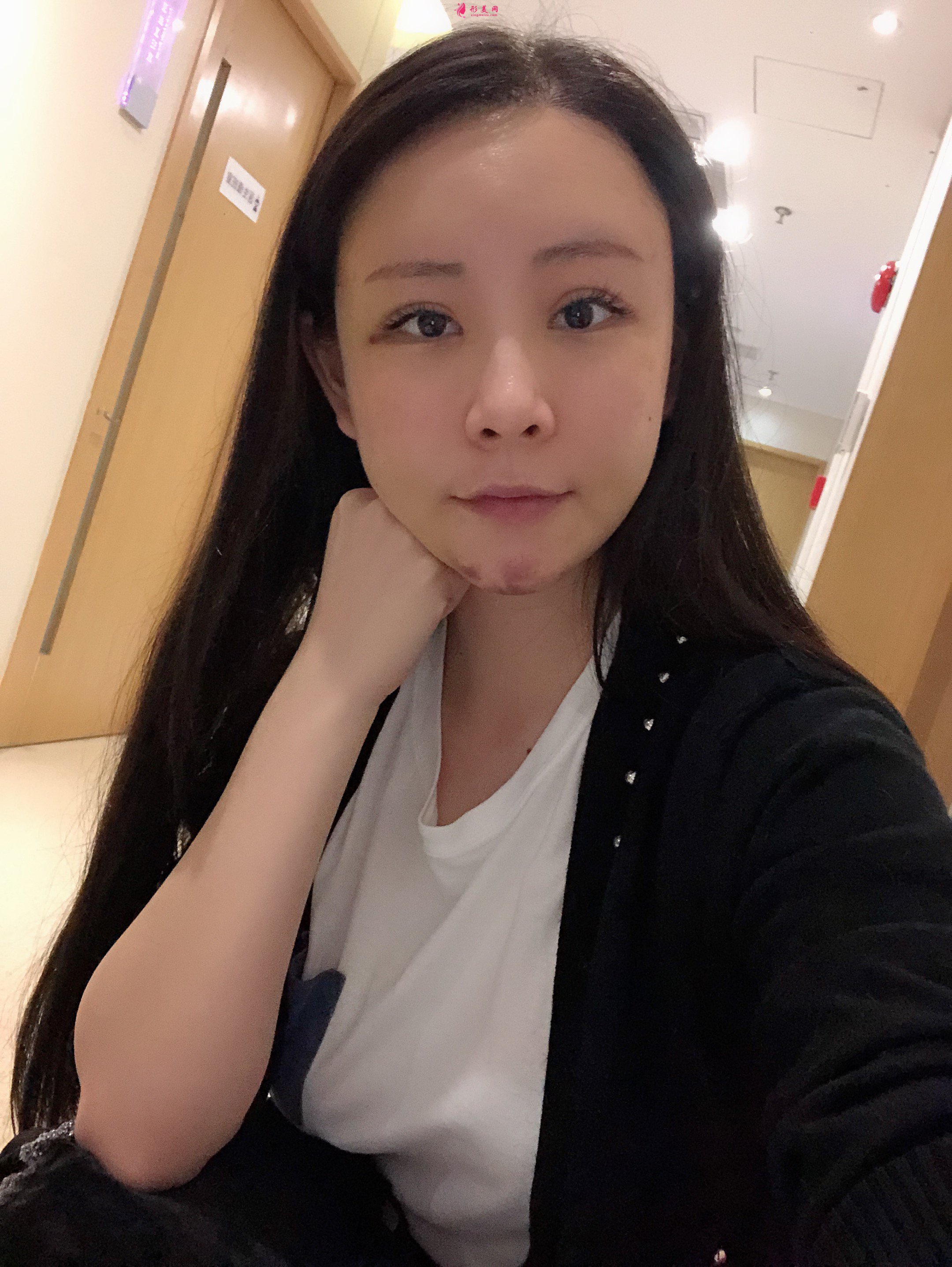 上海美莱医疗美容价格表，附自体脂肪丰额头案例分享