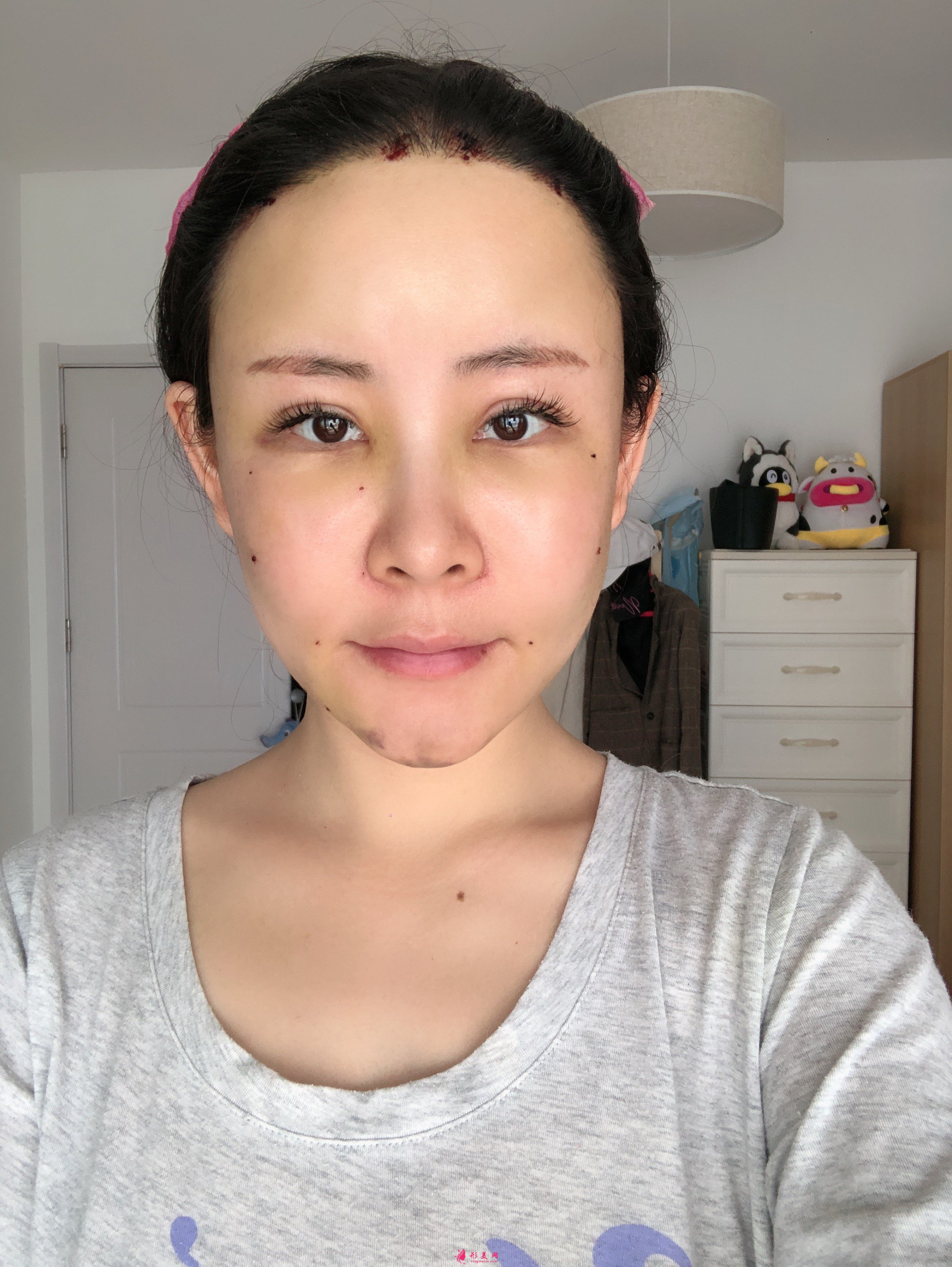 上海美莱医疗美容价格表，附自体脂肪丰额头案例分享